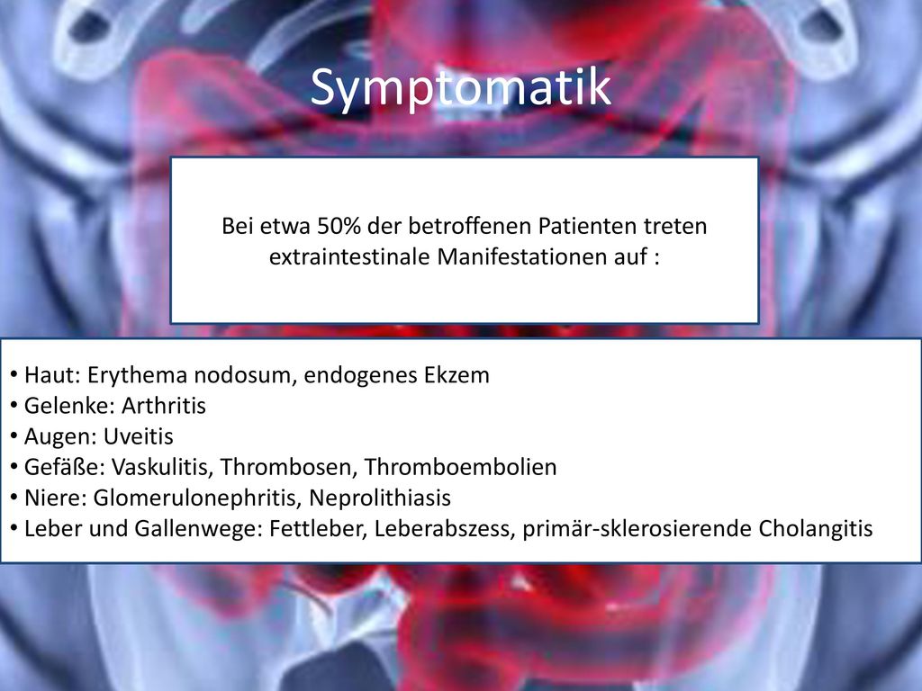 Symptomatik Bei etwa 50% der betroffenen Patienten treten extraintestinale Manifestationen auf : Haut: Erythema nodosum, endogenes Ekzem.