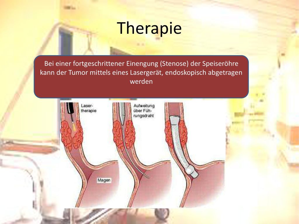 Therapie Bei einer fortgeschrittener Einengung (Stenose) der Speiseröhre kann der Tumor mittels eines Lasergerät, endoskopisch abgetragen werden.