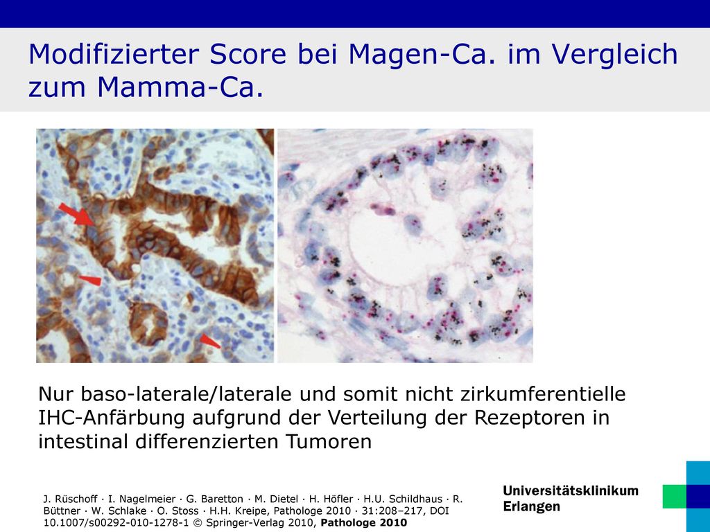 Modifizierter Score bei Magen-Ca. im Vergleich zum Mamma-Ca.