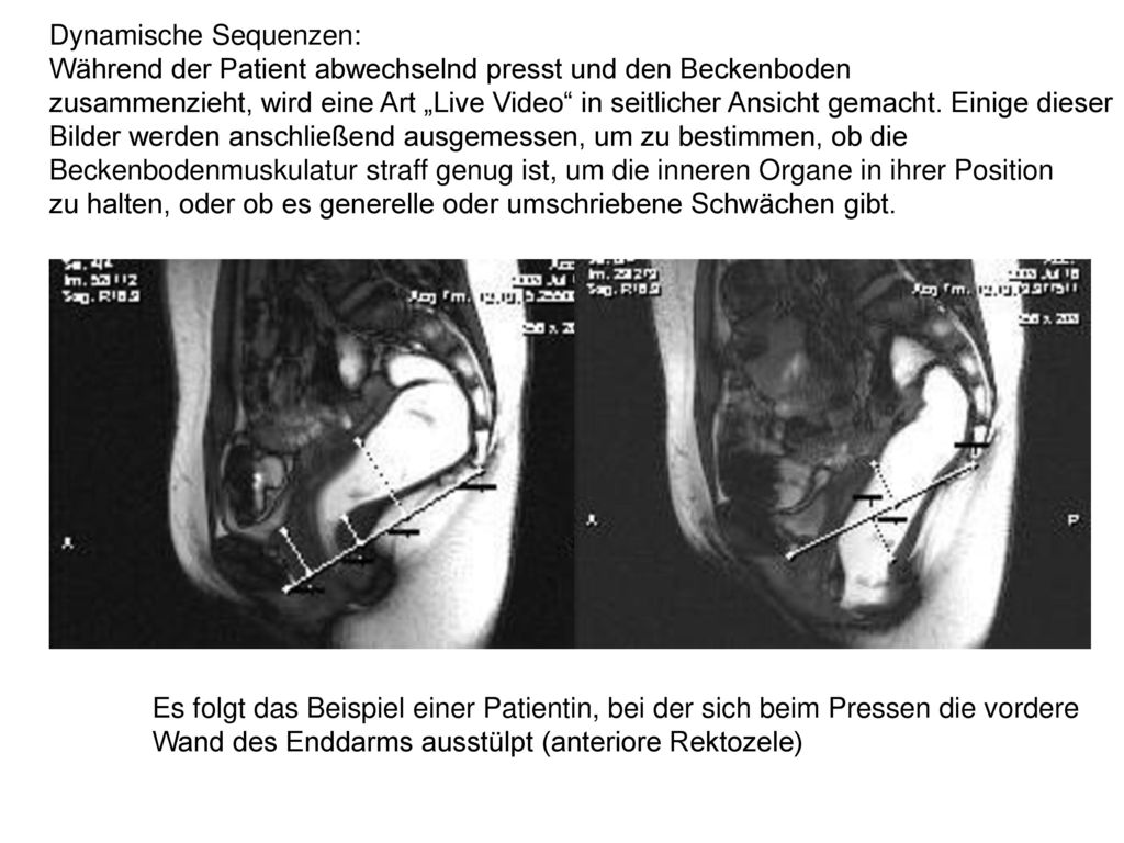 Dynamische Sequenzen: Während der Patient abwechselnd presst und den Beckenboden zusammenzieht, wird eine Art „Live Video in seitlicher Ansicht gemacht. Einige dieser Bilder werden anschließend ausgemessen, um zu bestimmen, ob die