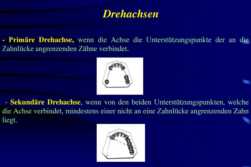 Drehachsen - Primäre Drehachse, wenn die Achse die Unterstützungspunkte der an die Zahnlücke angrenzenden Zähne verbindet.