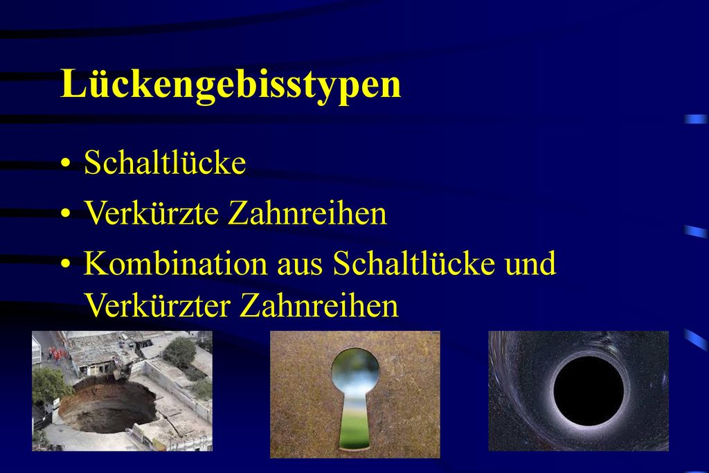 Lückengebisstypen Schaltlücke Verkürzte Zahnreihen
