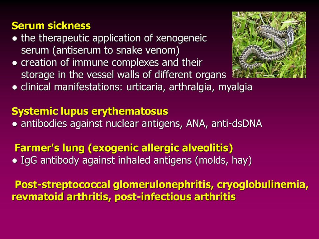 Serum sickness ● the therapeutic application of xenogeneic serum (antiserum to snake venom)