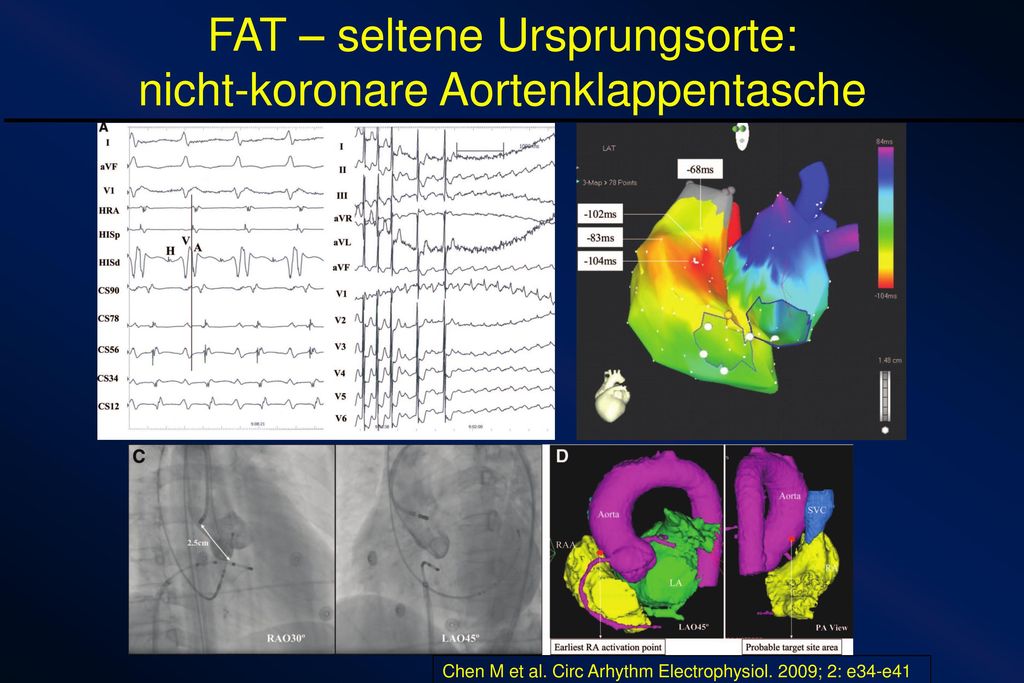 FAT – seltene Ursprungsorte: nicht-koronare Aortenklappentasche