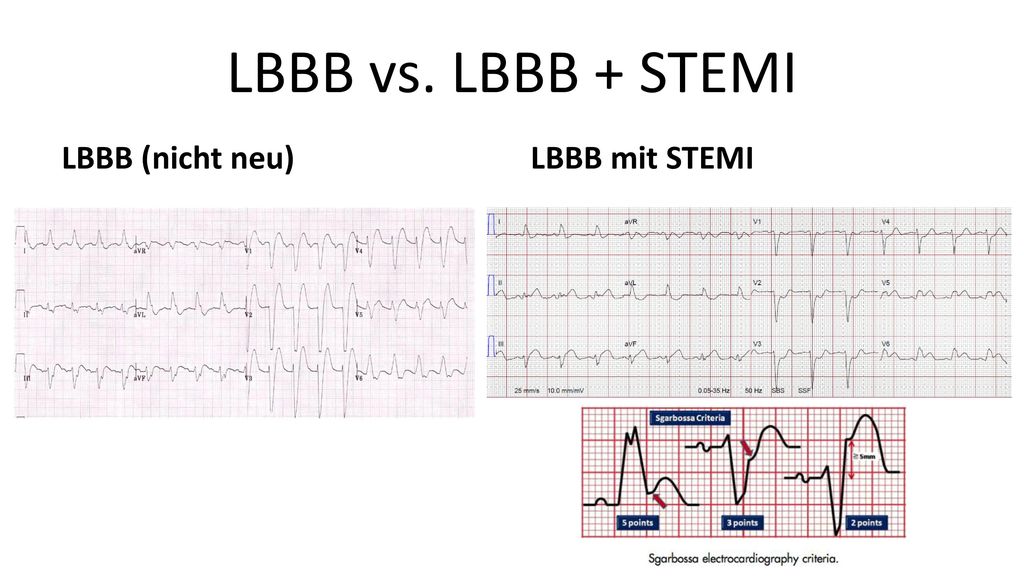 LBBB vs. LBBB + STEMI LBBB (nicht neu) LBBB mit STEMI