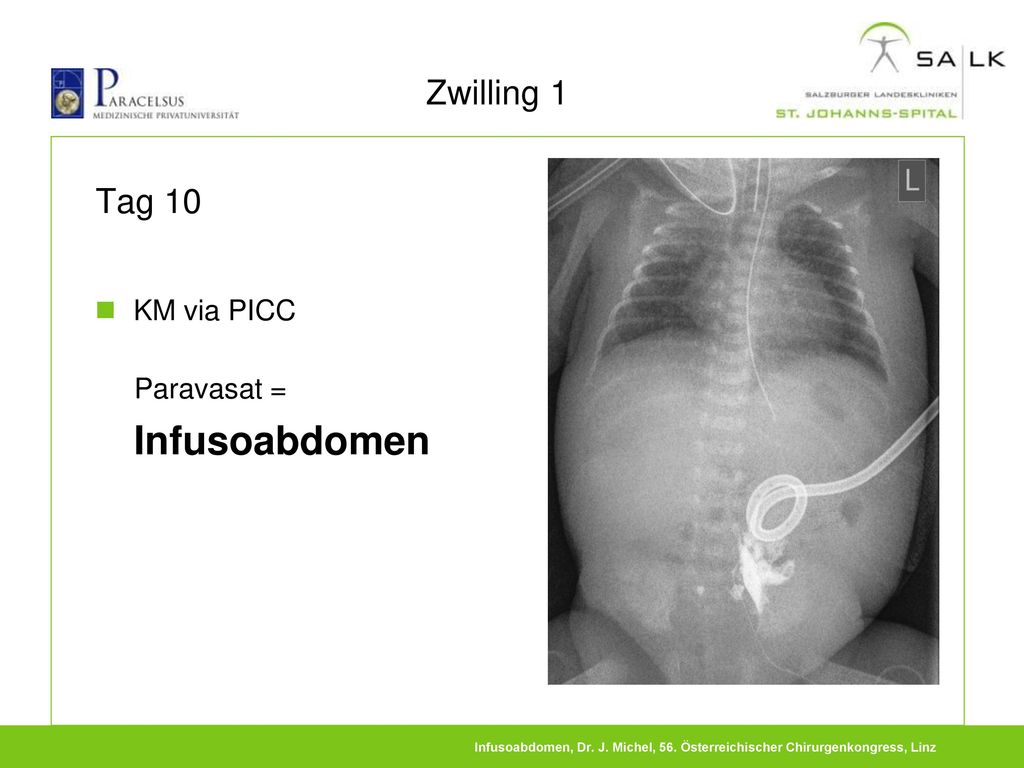 Zwilling 1 Tag 10 Paravasat = KM via PICC Infusoabdomen