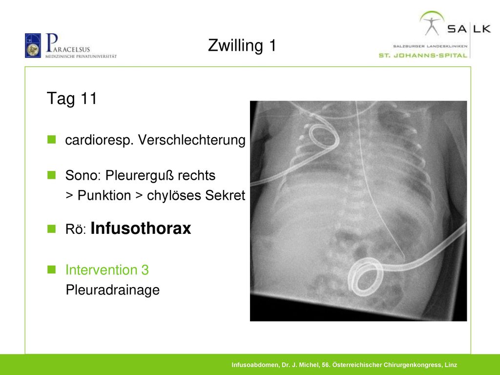 Zwilling 1 Tag 11 cardioresp. Verschlechterung Sono: Pleurerguß rechts
