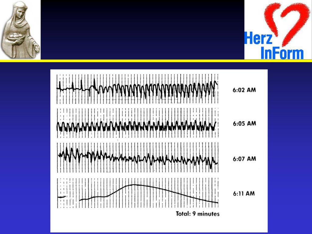 Defibrillation must be delivered within minutes of a cardiac arrest in order to have the best chance of success.