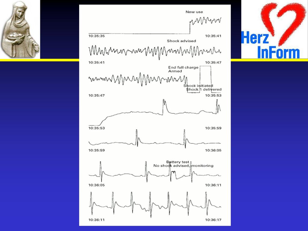 Disposable defibrillation electrodes are placed on the patient s bare chest in the anterior-lateral position. Remove excessive chest hair, sweat, and medication patches before applying the electrodes.
