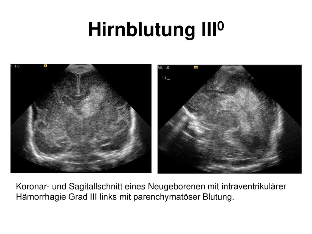 Hirnblutung III0 Koronar- und Sagitallschnitt eines Neugeborenen mit intraventrikulärer Hämorrhagie Grad III links mit parenchymatöser Blutung.