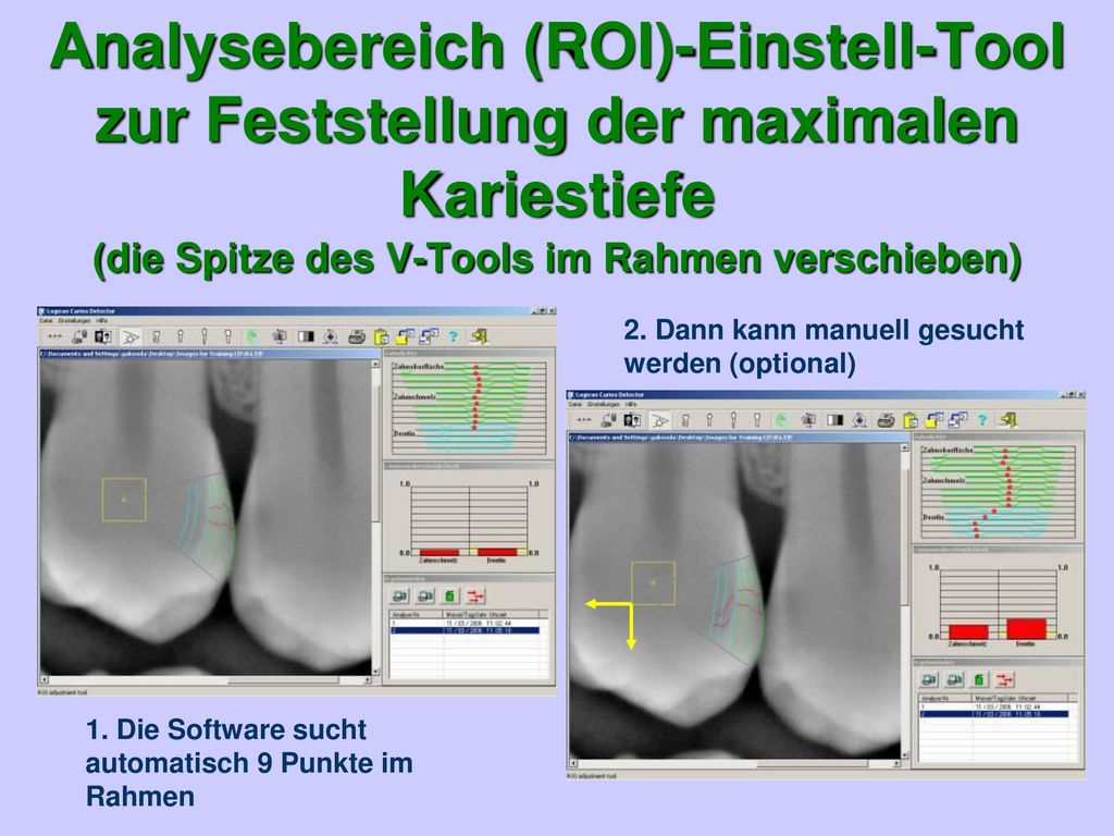Analysebereich (ROI)-Einstell-Tool zur Feststellung der maximalen Kariestiefe (die Spitze des V-Tools im Rahmen verschieben)