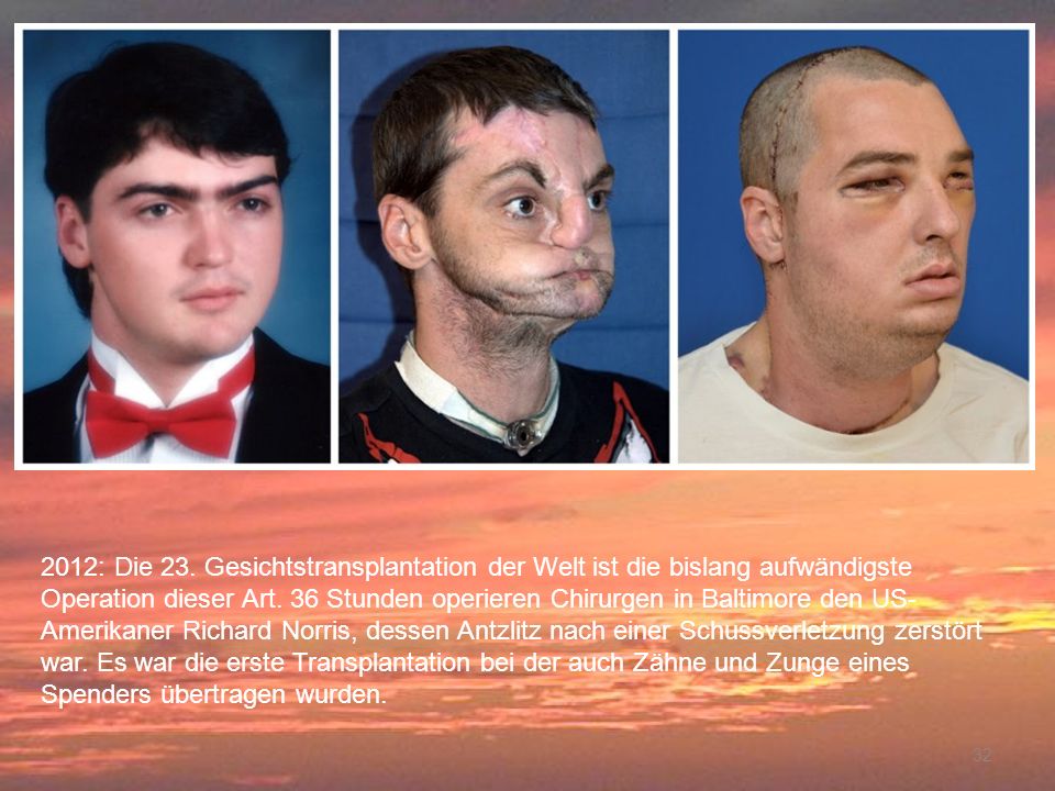 2012: Die 23. Gesichtstransplantation der Welt ist die bislang aufwändigste Operation dieser Art. 36 Stunden operieren Chirurgen in Baltimore den US-Amerikaner Richard Norris, dessen Antzlitz nach einer Schussverletzung zerstört war. Es war die erste Transplantation bei der auch Zähne und Zunge eines Spenders übertragen wurden.