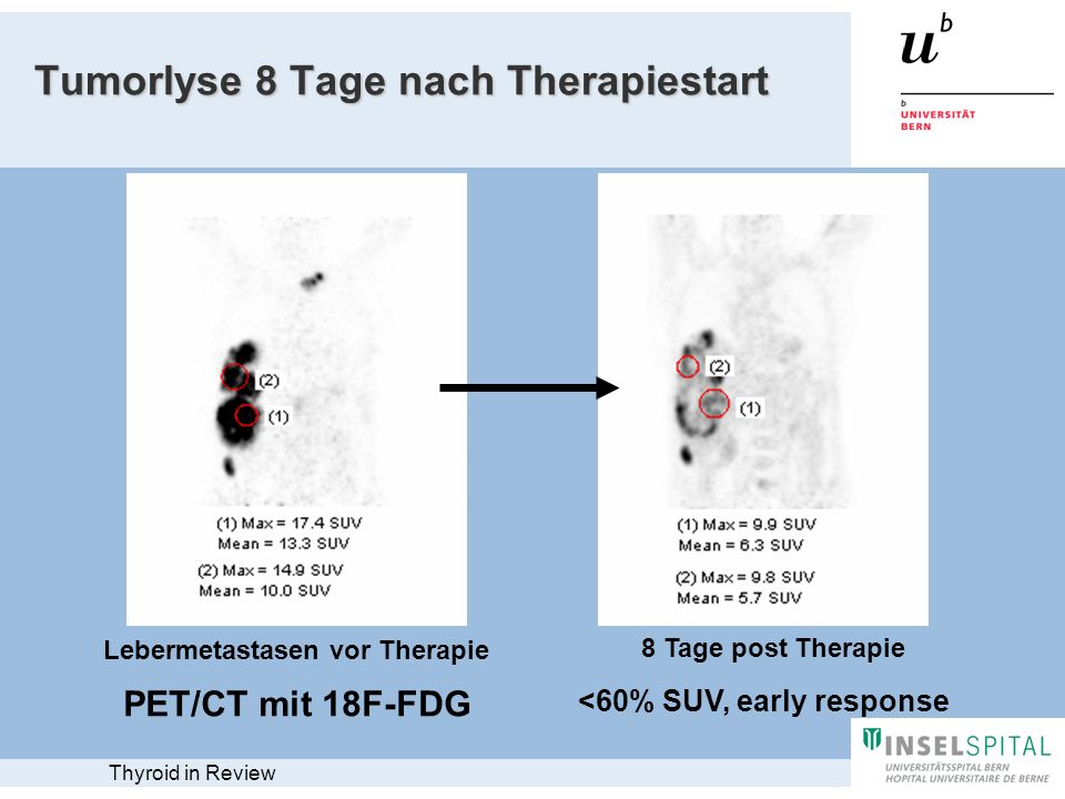 Tumorlyse 8 Tage nach Therapiestart