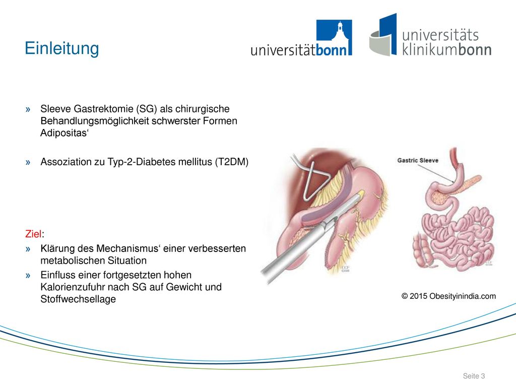 Einleitung Sleeve Gastrektomie (SG) als chirurgische Behandlungsmöglichkeit schwerster Formen Adipositas‘