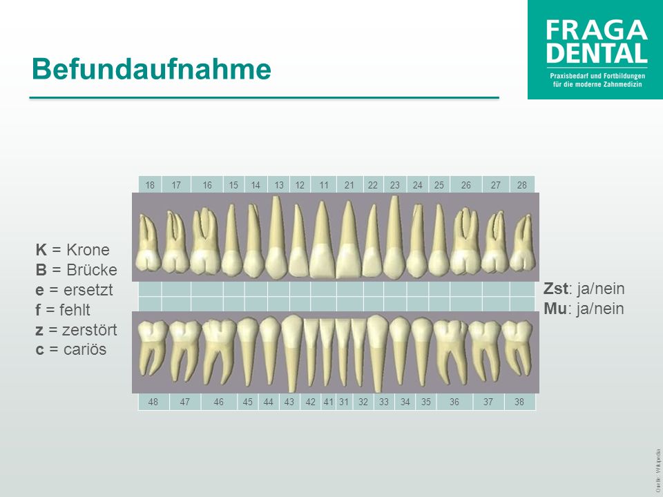Befundaufnahme K = Krone B = Brücke e = ersetzt f = fehlt z = zerstört