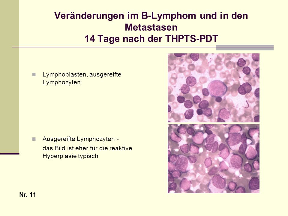 Veränderungen im B-Lymphom und in den Metastasen 14 Tage nach der THPTS-PDT