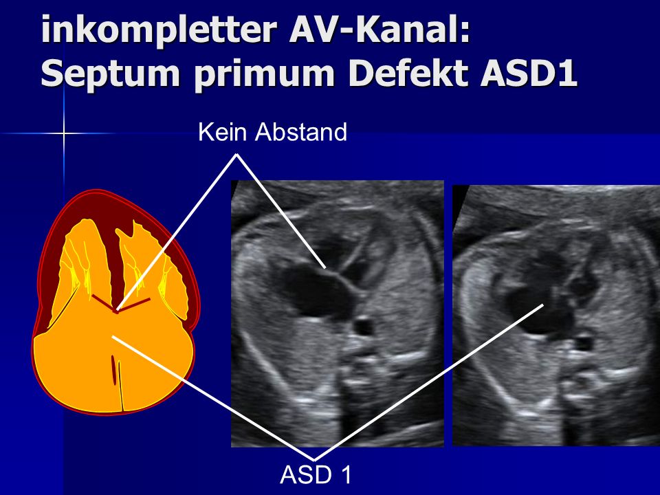 inkompletter AV-Kanal: Septum primum Defekt ASD1