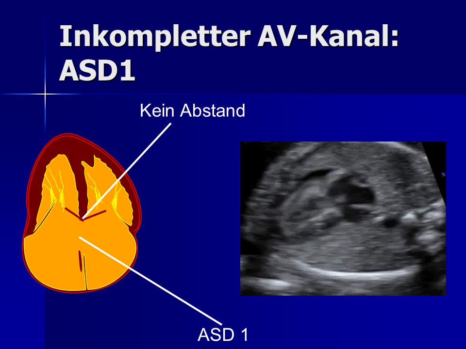 Inkompletter AV-Kanal: ASD1