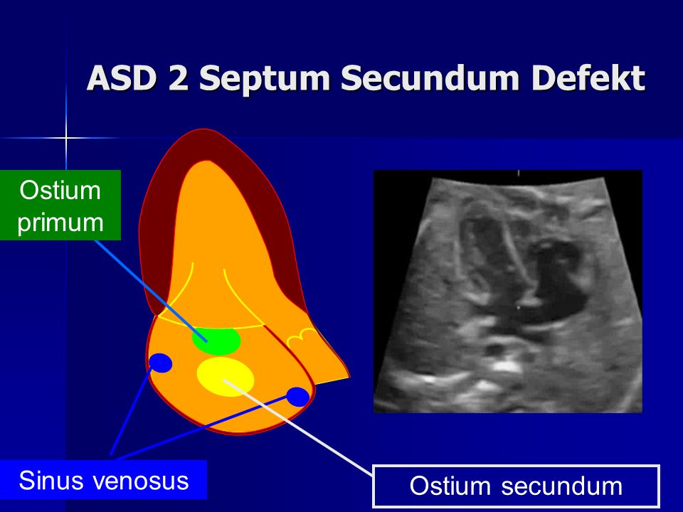 ASD 2 Septum Secundum Defekt