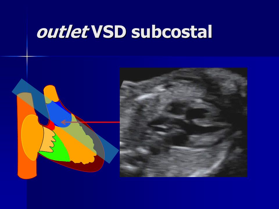 outlet VSD subcostal