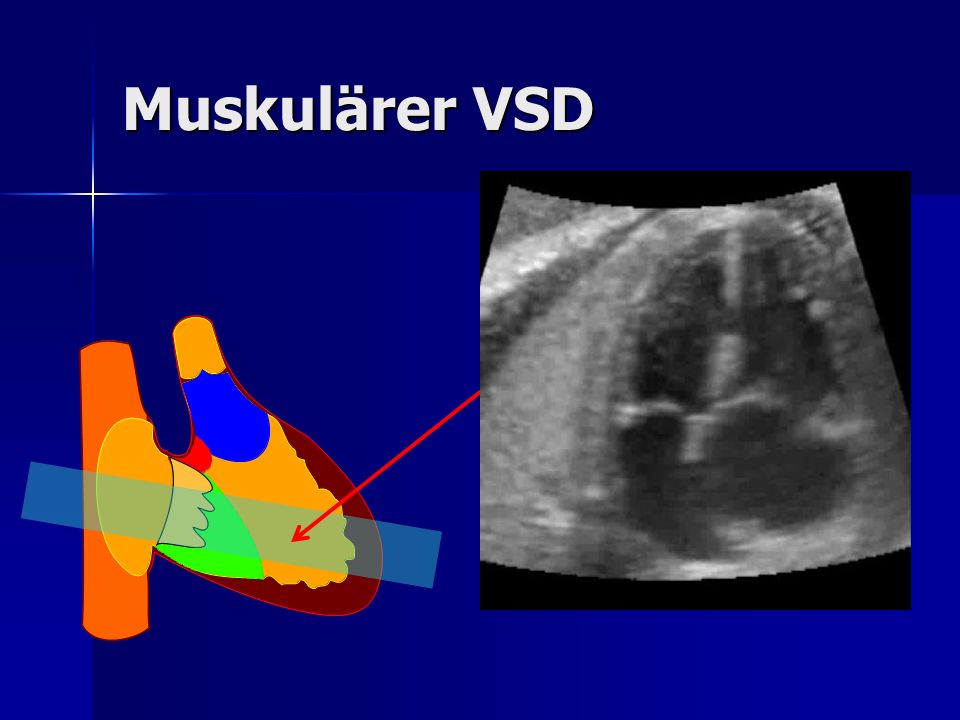 Muskulärer VSD I difetti muscolari sono caratterizzati da soluzioni di continuo nel contesto del setto interventricolare, di differenti dimensioni.