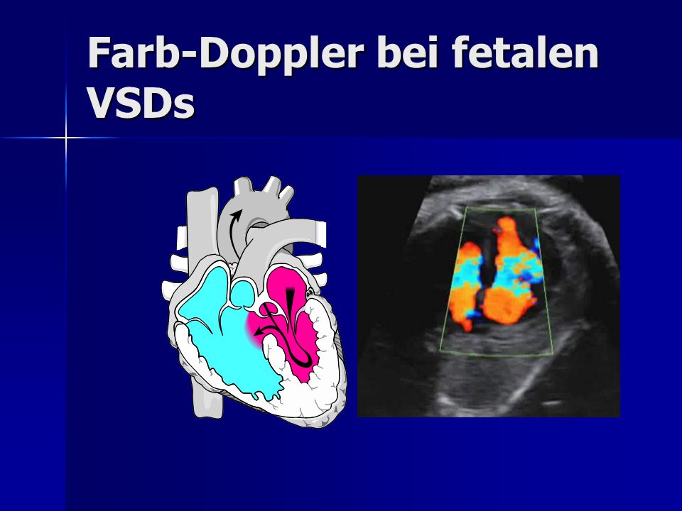 Farb-Doppler bei fetalen VSDs