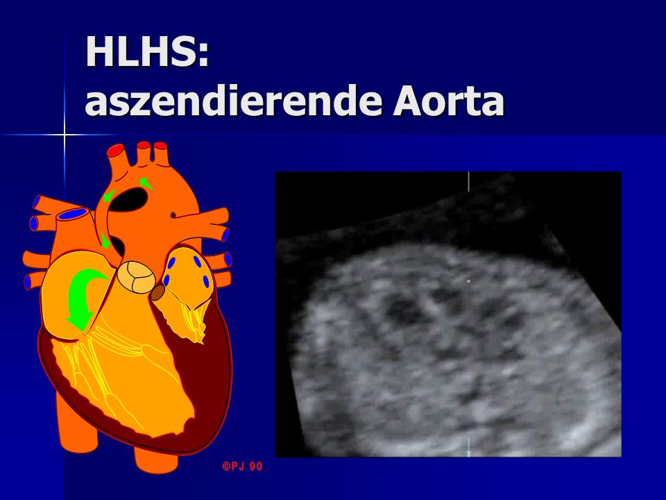 HLHS: aszendierende Aorta