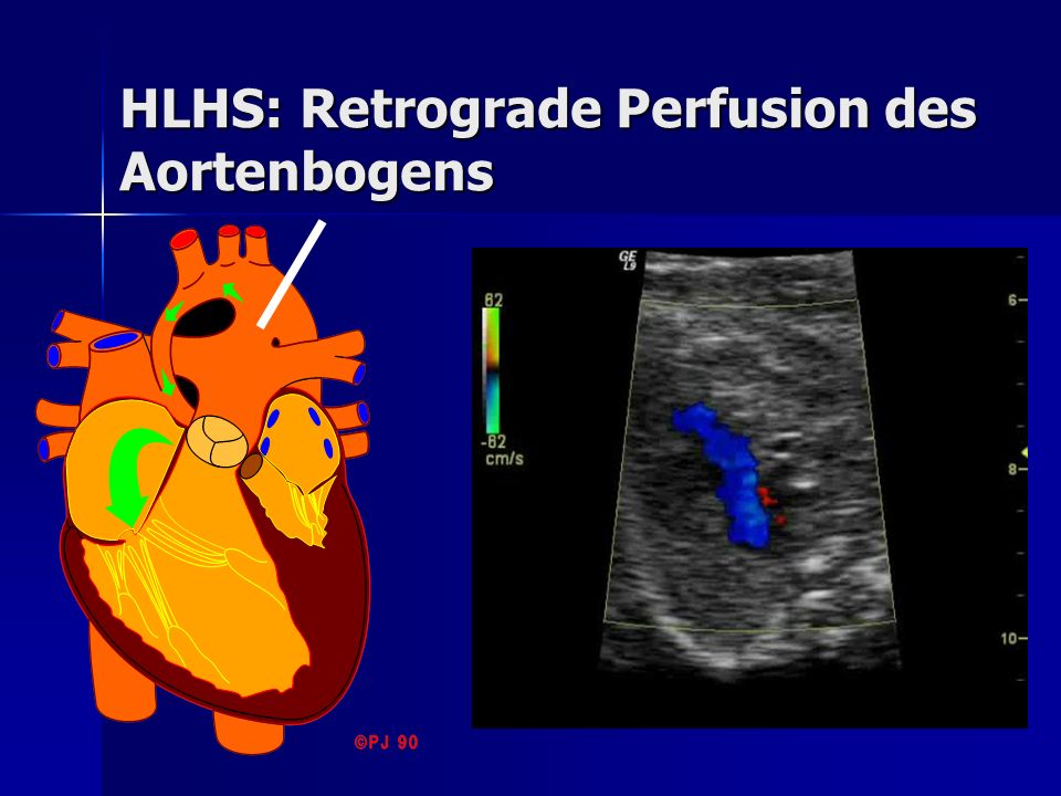 HLHS: Retrograde Perfusion des Aortenbogens