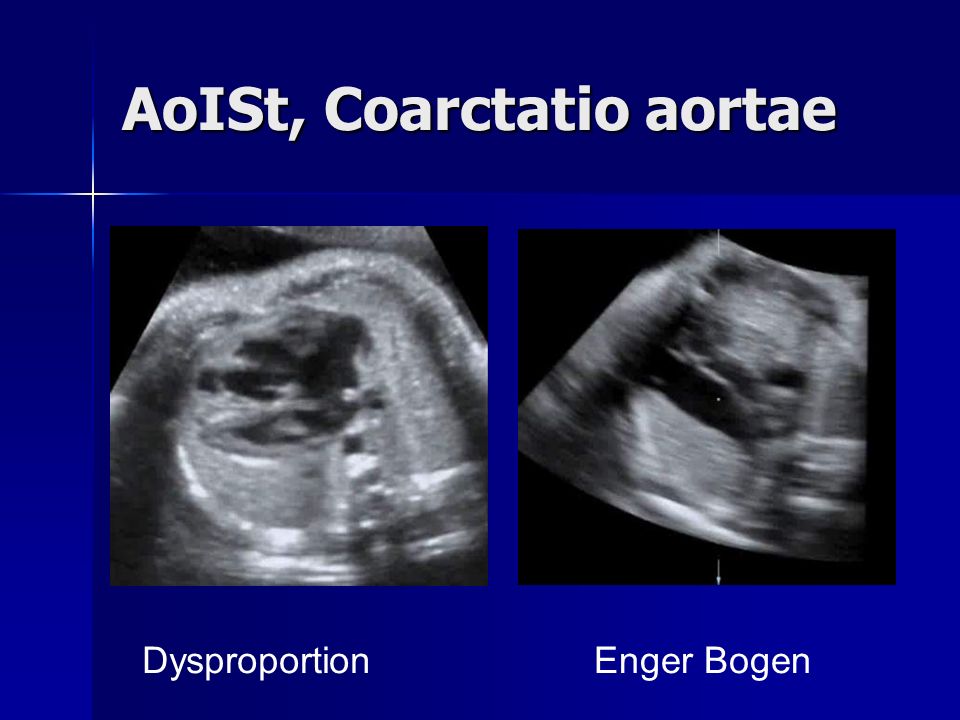 AoISt, Coarctatio aortae