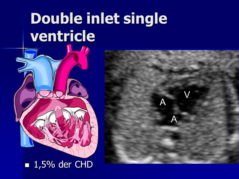Double inlet single ventricle