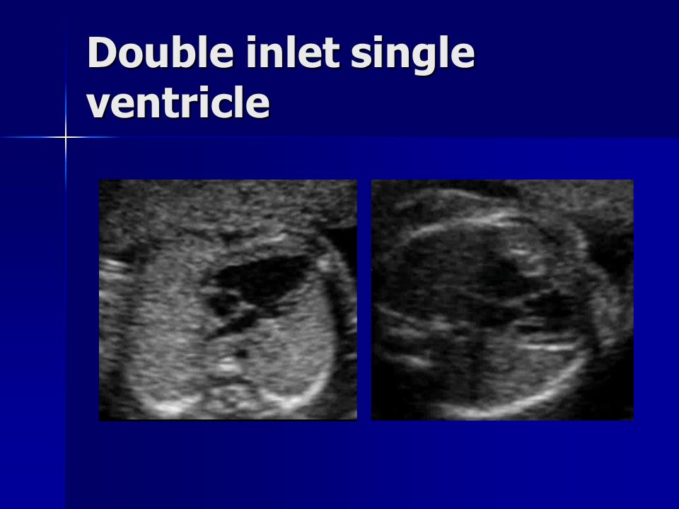 Double inlet single ventricle
