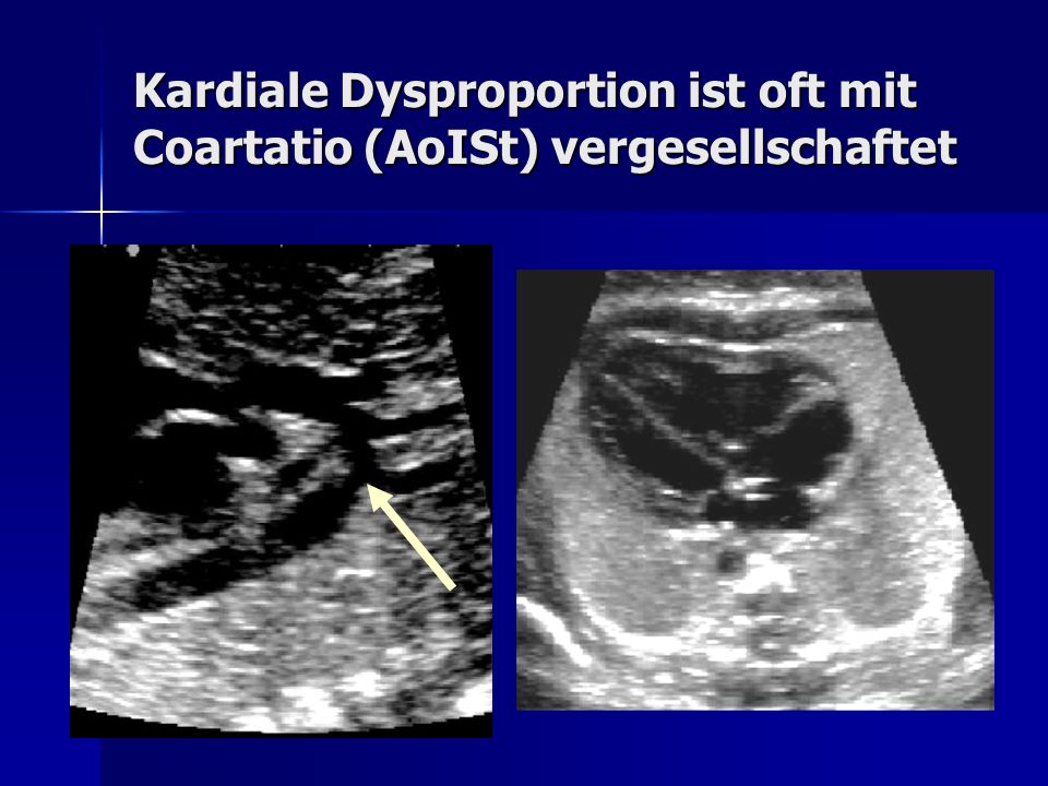 Kardiale Dysproportion ist oft mit Coartatio (AoISt) vergesellschaftet