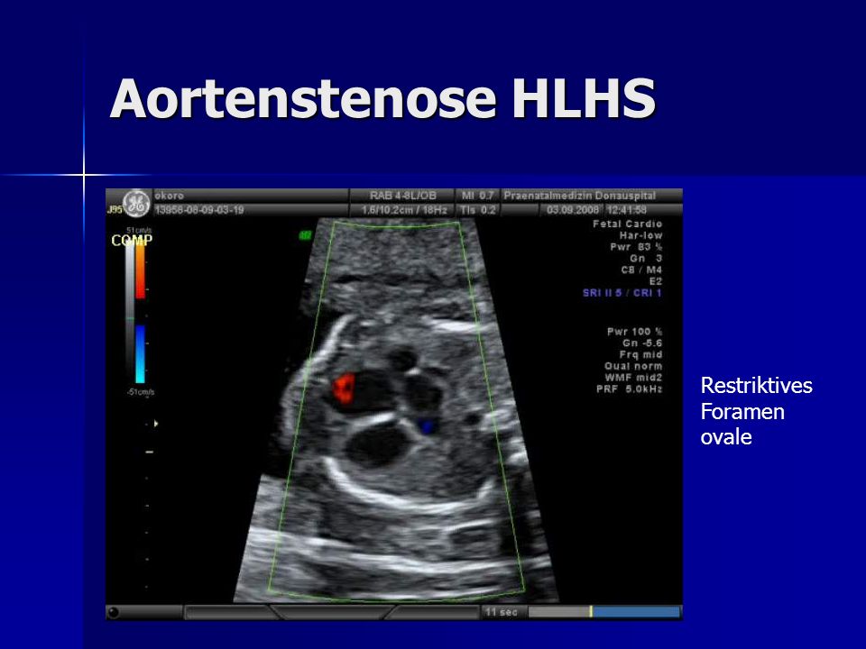 Aortenstenose HLHS Restriktives Foramen ovale