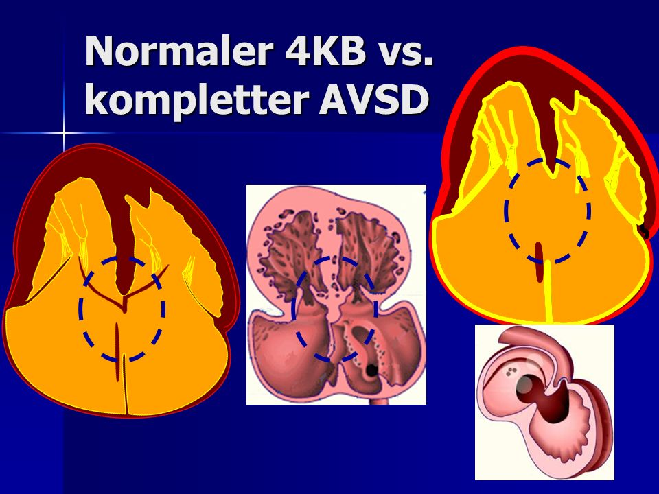 Normaler 4KB vs. kompletter AVSD