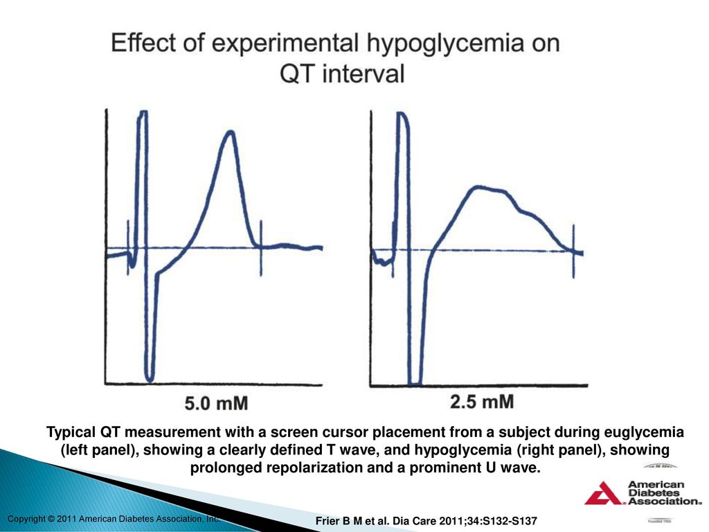 Typical QT measurement with a screen cursor placement from a subject during euglycemia (left panel), showing a clearly defined T wave, and hypoglycemia (right panel), showing prolonged repolarization and a prominent U wave. Reproduced from Marques et al. (20) with permission from John Wiley & Sons.