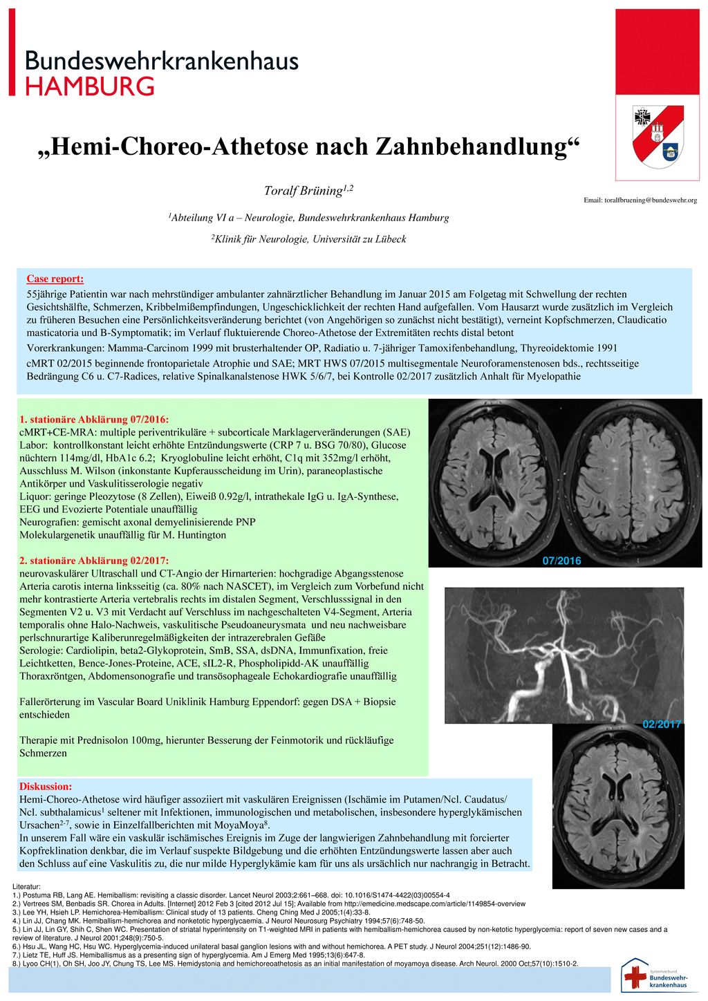„Hemi-Choreo-Athetose nach Zahnbehandlung Toralf Brüning1,2 1Abteilung VI a – Neurologie, Bundeswehrkrankenhaus Hamburg 2Klinik für Neurologie, Universität zu Lübeck