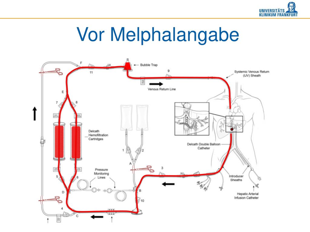 Vor Melphalangabe Vor der Gabe des Zytostatikums werden die beiden Filter nacheinander mit Blut geflutet.