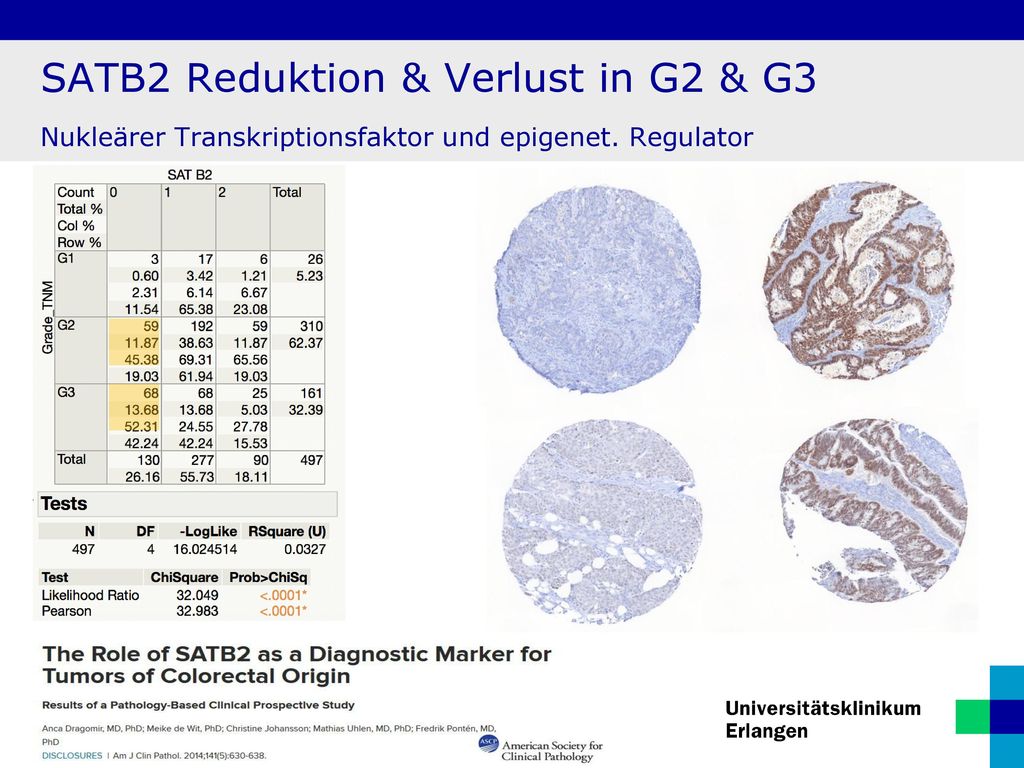 SATB2 Reduktion & Verlust in G2 & G3 Nukleärer Transkriptionsfaktor und epigenet. Regulator
