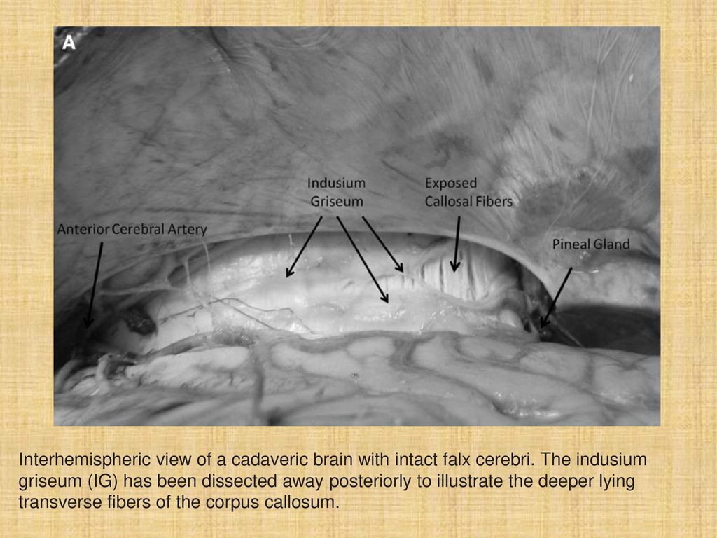 Tubbs, Neurosurgery 2013 interhemispheric view of a cadaveric brain with intact falx cerebri. The indusium griseum (IG) has been dissected.