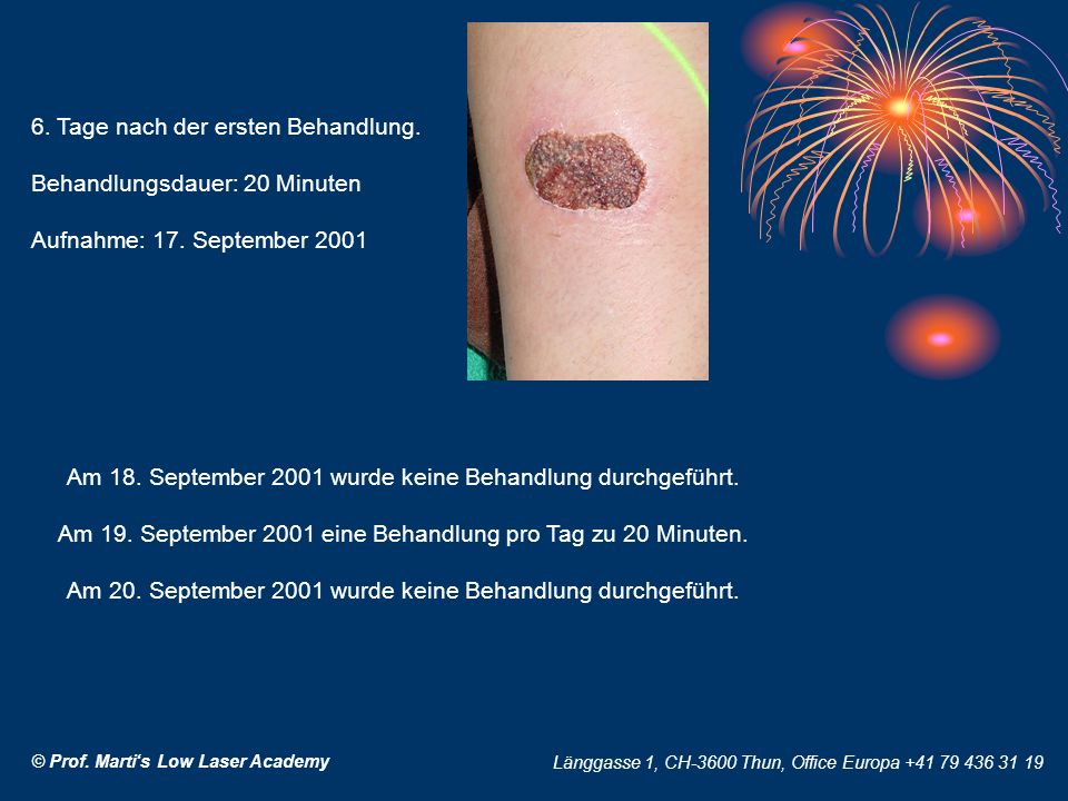 6. Tage nach der ersten Behandlung. Behandlungsdauer: 20 Minuten