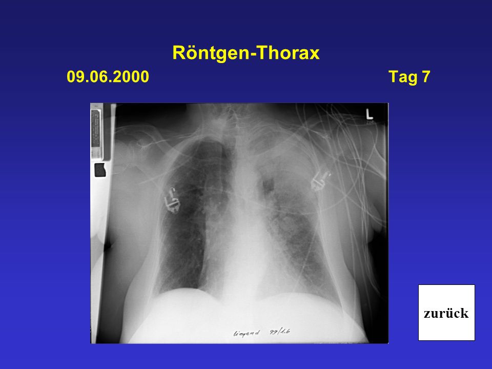 Röntgen-Thorax Tag 7 zurück