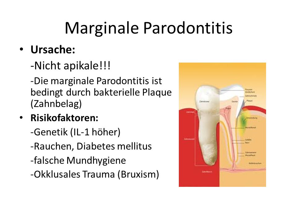 Marginale Parodontitis