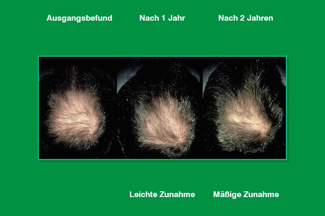 Ausgangsbefund Nach 1 Jahr Nach 2 Jahren Leichte Zunahme Mäßige Zunahme
