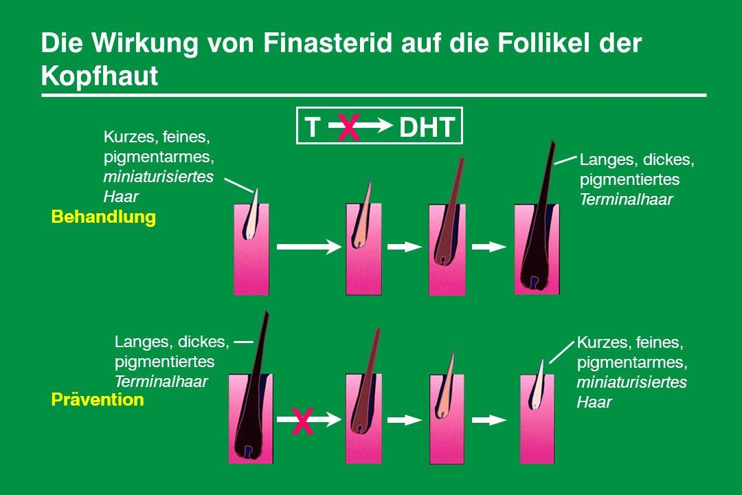 X X Die Wirkung von Finasterid auf die Follikel der Kopfhaut T DHT