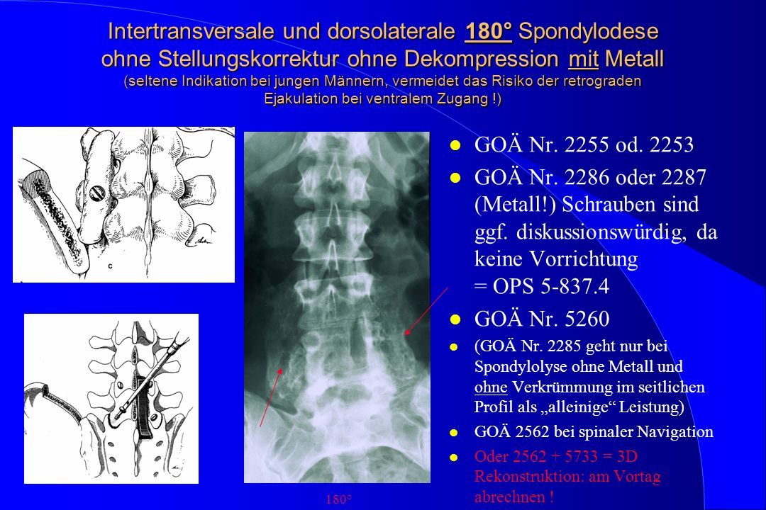 Intertransversale und dorsolaterale 180° Spondylodese ohne Stellungskorrektur ohne Dekompression mit Metall (seltene Indikation bei jungen Männern, vermeidet das Risiko der retrograden Ejakulation bei ventralem Zugang !)