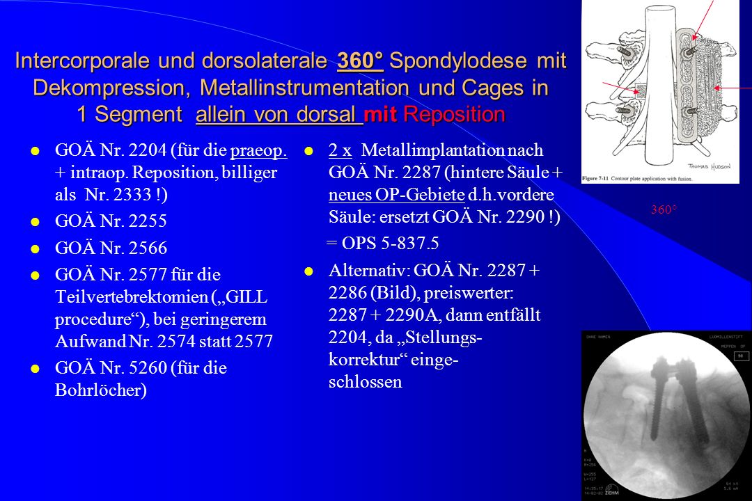 Intercorporale und dorsolaterale 360° Spondylodese mit Dekompression, Metallinstrumentation und Cages in 1 Segment allein von dorsal mit Reposition