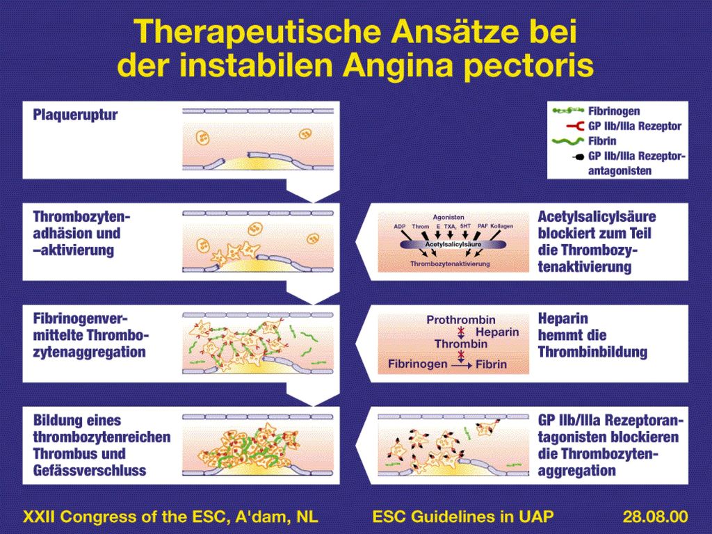 XXII Congress of the ESC, A‘dam, NL ESC Guidelines in UAP
