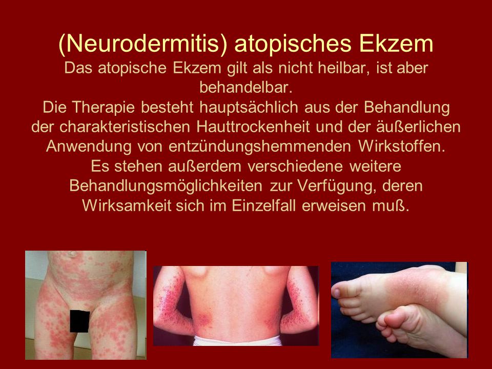 (Neurodermitis) atopisches Ekzem Das atopische Ekzem gilt als nicht heilbar, ist aber behandelbar.