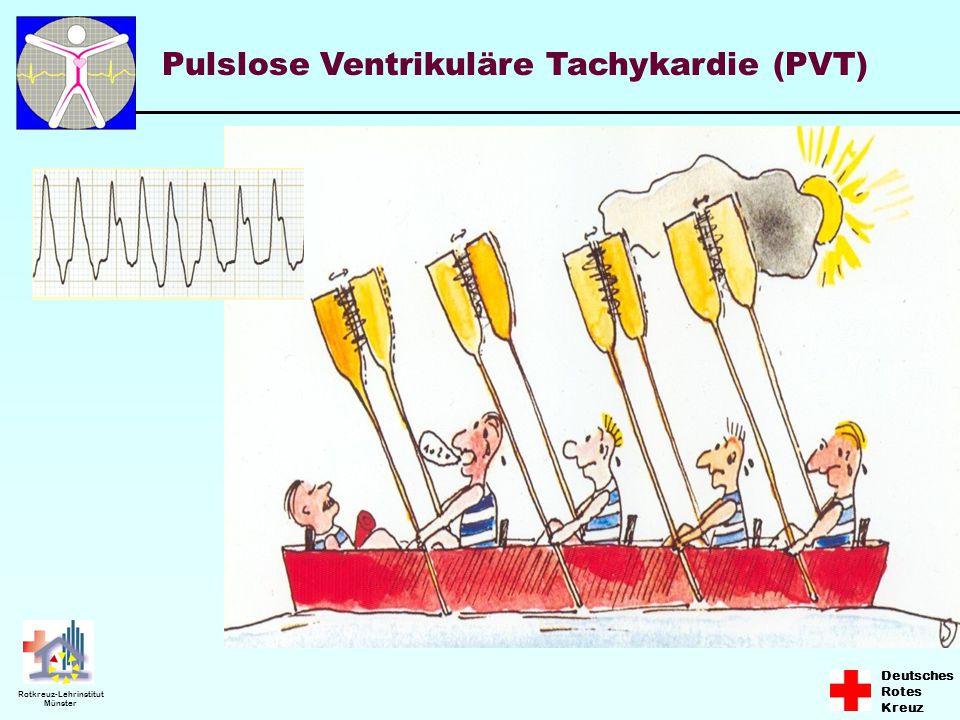 Pulslose Ventrikuläre Tachykardie (PVT)