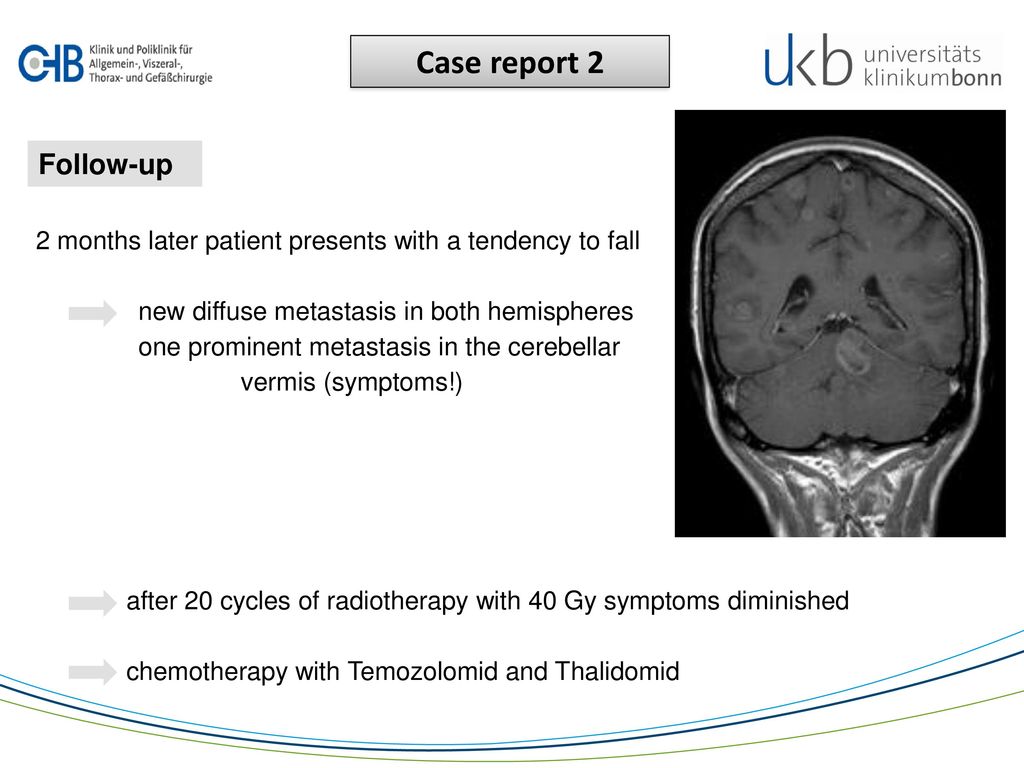 Case report 2 Follow-up. 2 months later patient presents with a tendency to fall. new diffuse metastasis in both hemispheres.